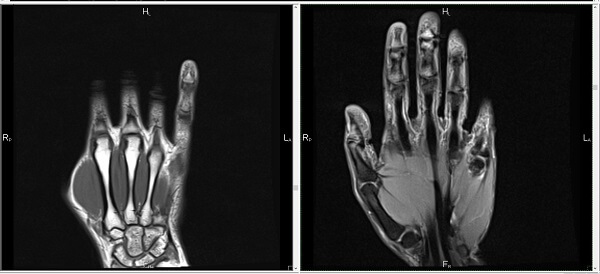 Снимок МРТ кисти и лучезапястного сустава