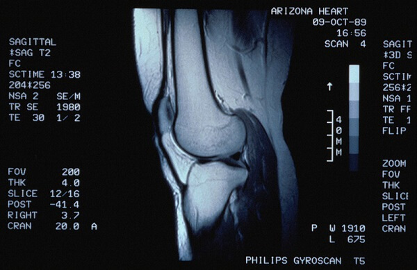 снимок МРТ коленного сустава