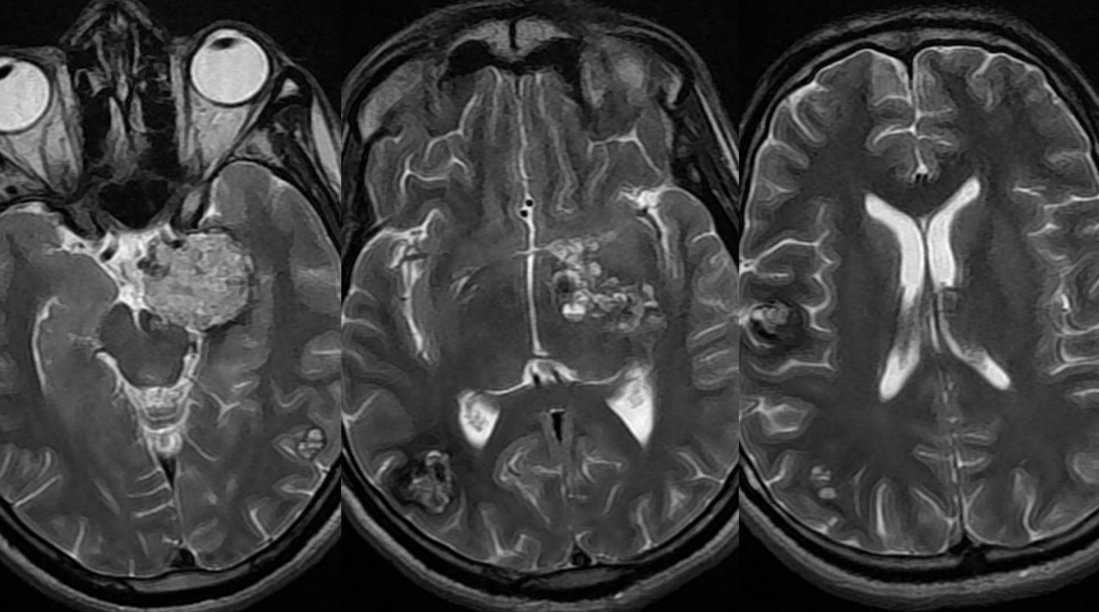 фотография МРТ головного мозга